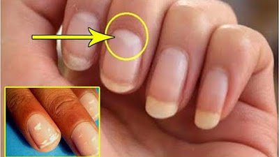 Red Alert: If You See This On Your Nails Immediately Visit A Doctor!